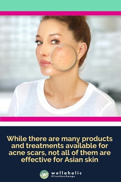 While there are many products and treatments available for acne scars, not all of them are effective for Asian skin