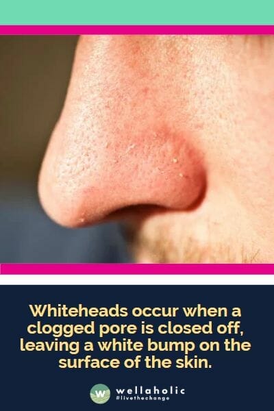 Whiteheads occur when a clogged pore is closed off, leaving a white bump on the surface of the skin.