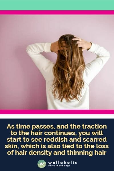 as time passes, and the traction to the hair continues, you will start to see reddish and scarred skin, which is also tied to the loss of hair density and thinning hair