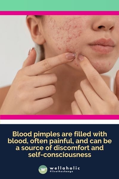 blood pimples are filled with blood, often painful, and can be a source of discomfort and self-consciousness