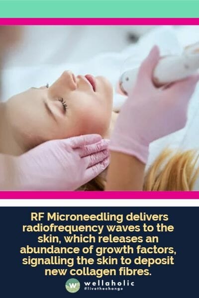  radiofrequency waves to the skin, which releases an abundance of growth factors, signalling the skin to deposit new collagen fibres