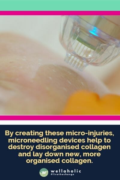 y creating these micro-injuries, microneedling devices help to destroy disorganised collagen and lay down new, more organised collagen.
