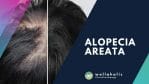 Androgenetic Alopecia