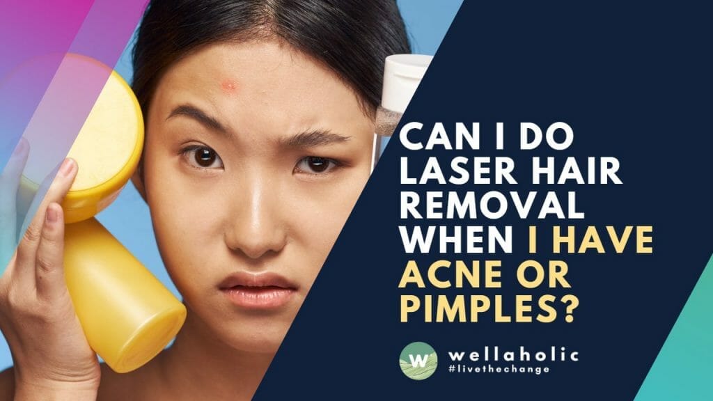 Can I do Laser Hair Removal When I have Acne or Pimples?