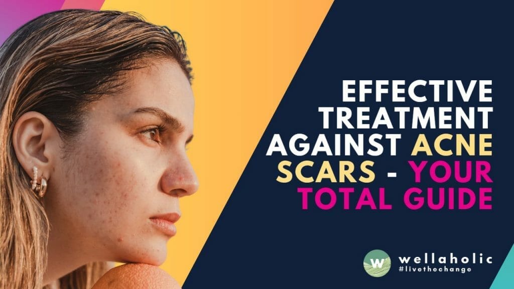Effective Treatment Against Acne Scars - Your Total Guide