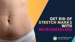 Say goodbye to stretch marks once and for all! Discover the power of microneedling in our guide. Learn how this treatment can fade and diminish stretch marks. Don't miss out on this transformative solution - Read on to unveil the key to smooth, flawless skin!