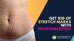 Say goodbye to stretch marks once and for all! Discover the power of microneedling in our guide. Learn how this treatment can fade and diminish stretch marks. Don't miss out on this transformative solution - Read on to unveil the key to smooth, flawless skin!