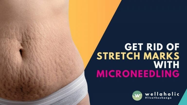 Say goodbye to stretch marks once and for all! Discover the power of microneedling in our guide. Learn how this treatment can fade and diminish stretch marks. Don't miss out on this transformative solution - Read on to unveil the key to smooth, flawless skin!