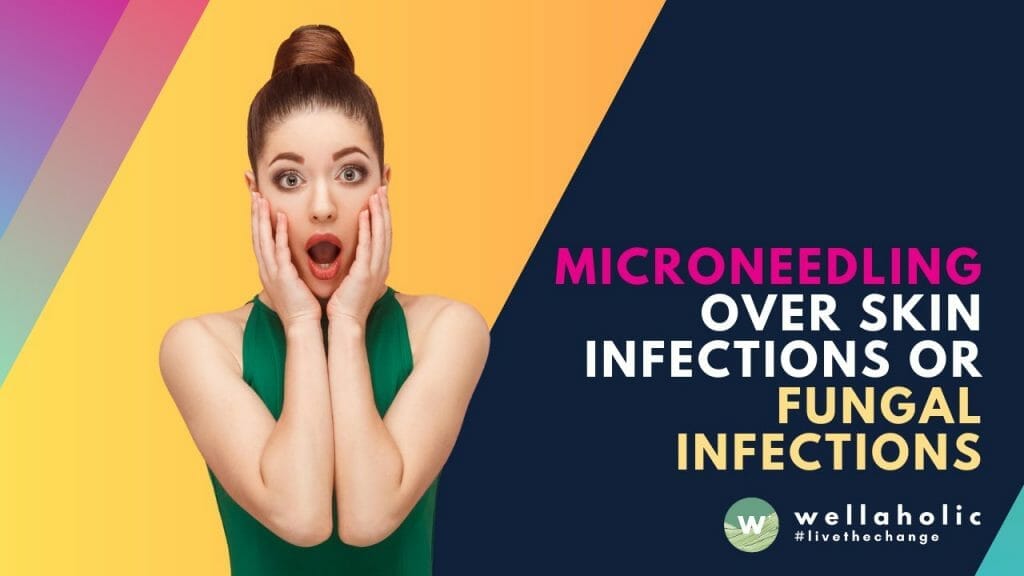 Microneedling Over Skin Infections or Fungal Infections