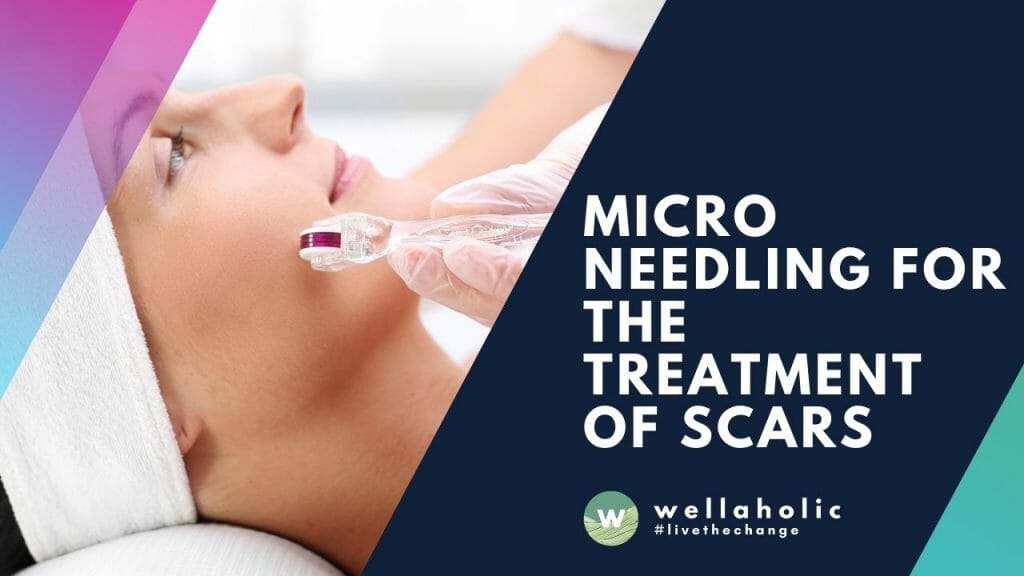 Microneedling for the Treatment of Scars