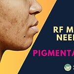 Discover advanced RF microneedling treatments like Gold RF and Sylfirm in Singapore, designed to treat pigmentation, melasma, and acne scars for radiant skin. Prices start at $399.