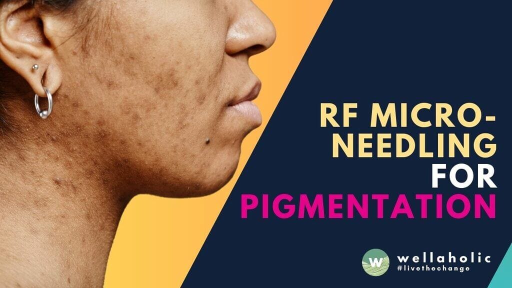 Discover advanced RF microneedling treatments like Gold RF and Sylfirm in Singapore, designed to treat pigmentation, melasma, and acne scars for radiant skin. Prices start at $399.