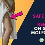 Yes, safe laser hair removal on scars, moles & after intimate surgery is possible in Singapore. Get expert guidance and understand the process for confident, smooth skin. Discover your options today.