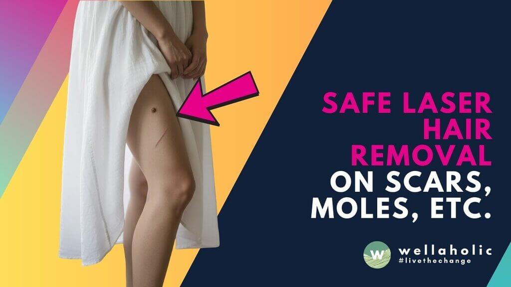 Yes, safe laser hair removal on scars, moles & after intimate surgery is possible in Singapore. Get expert guidance and understand the process for confident, smooth skin. Discover your options today.