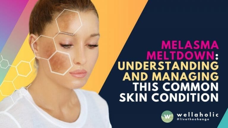 Struggling with melasma? Experience a meltdown with our ultimate guide! Understand and manage this common skin condition with expert tips and insights. Don't let melasma control your confidence - Read on to unveil the secrets to a clearer, brighter complexion!