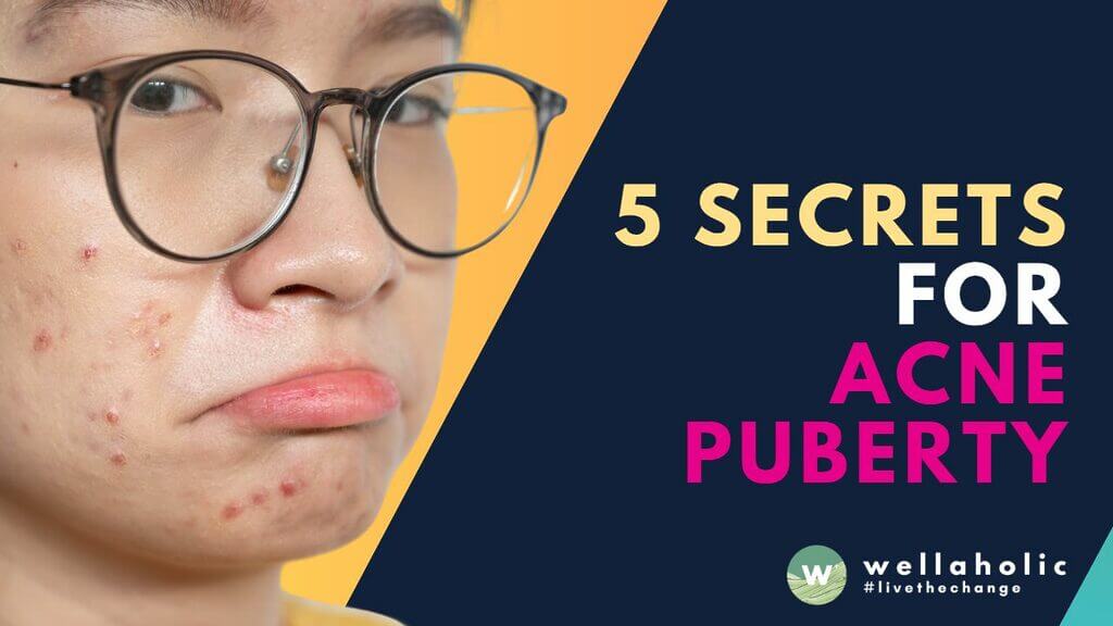 Discover 5 expert tips to banish acne and prevent pimples, even after puberty. Learn effective treatments and lifestyle changes for clear, healthy skin!