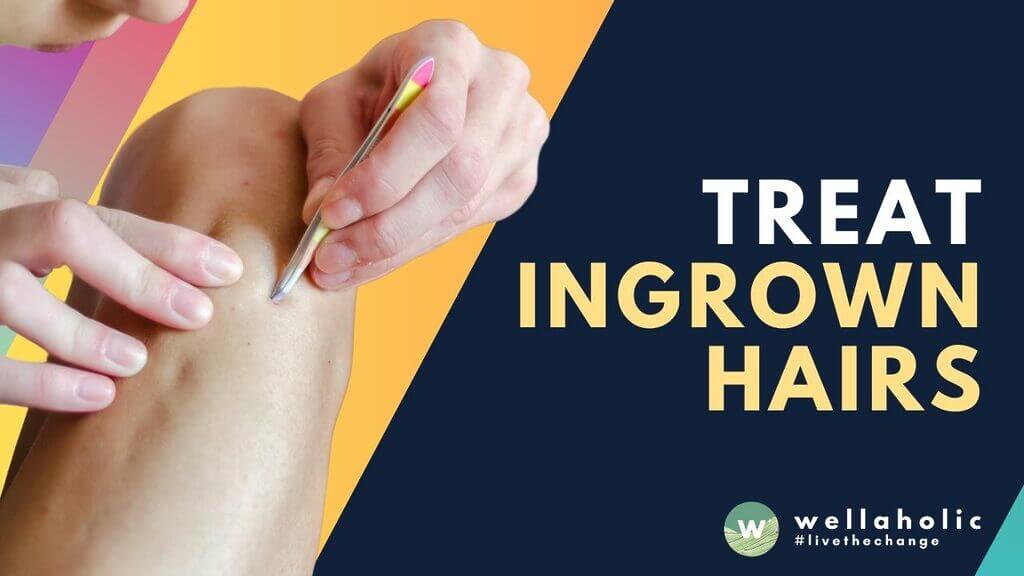 Say goodbye to ingrown hairs with laser hair removal in Singapore! Achieve smooth, hair-free skin with this long-lasting solution that's perfect for all skin types.