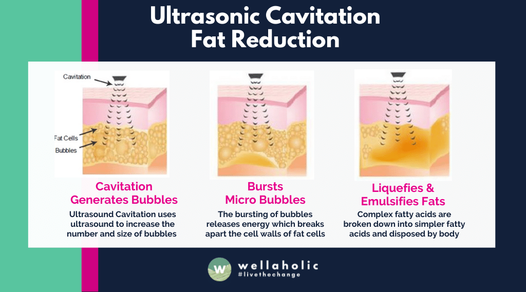 Ultrasonic fat cavitation is a non-invasive cosmetic procedure that uses ultrasound waves to break down and remove unwanted fat cells from specific areas of the body. This technology is designed to contour and shape the body, giving patients a slimmer and more toned appearance.

During an ultrasonic cavitation treatment, a specialized device delivers high-frequency ultrasound waves to the treatment area. These waves create micro-bubbles in the fat cells, causing them to rupture and release their contents. The body then naturally eliminates the destroyed fat cells, resulting in a reduction in the size of the treated area.
