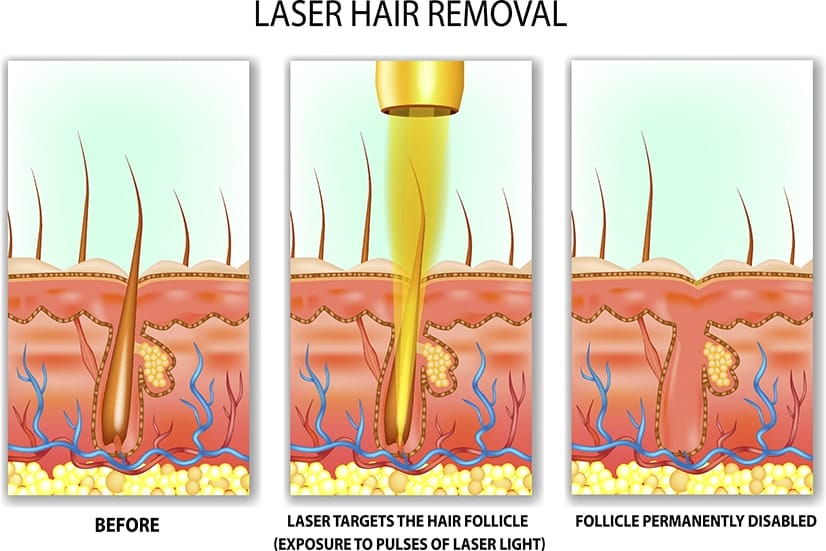 激光脱毛是通过选择性光热法的过程实现的。这是指将激光束设定为指定的波长。激光束被吸引到毛发中含有的黑色素上，而周围组织不受影响。
