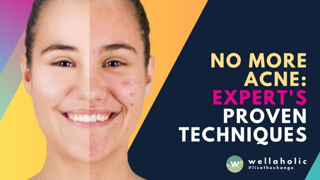 no more acne
