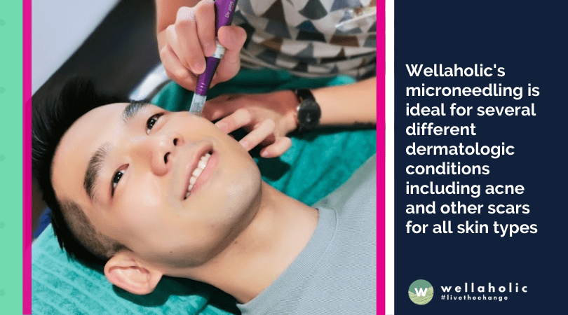 Wellaholic's microneedling is ideal for several different dermatologic conditions including acne and other scars for all skin types