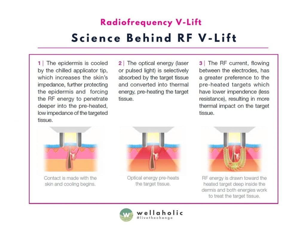 Science of RF Vlift