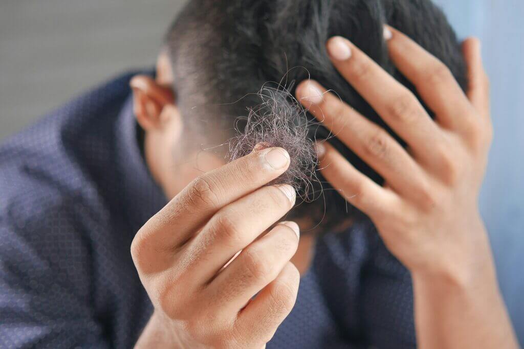 Scalp RF Microneedling for Hair Loss